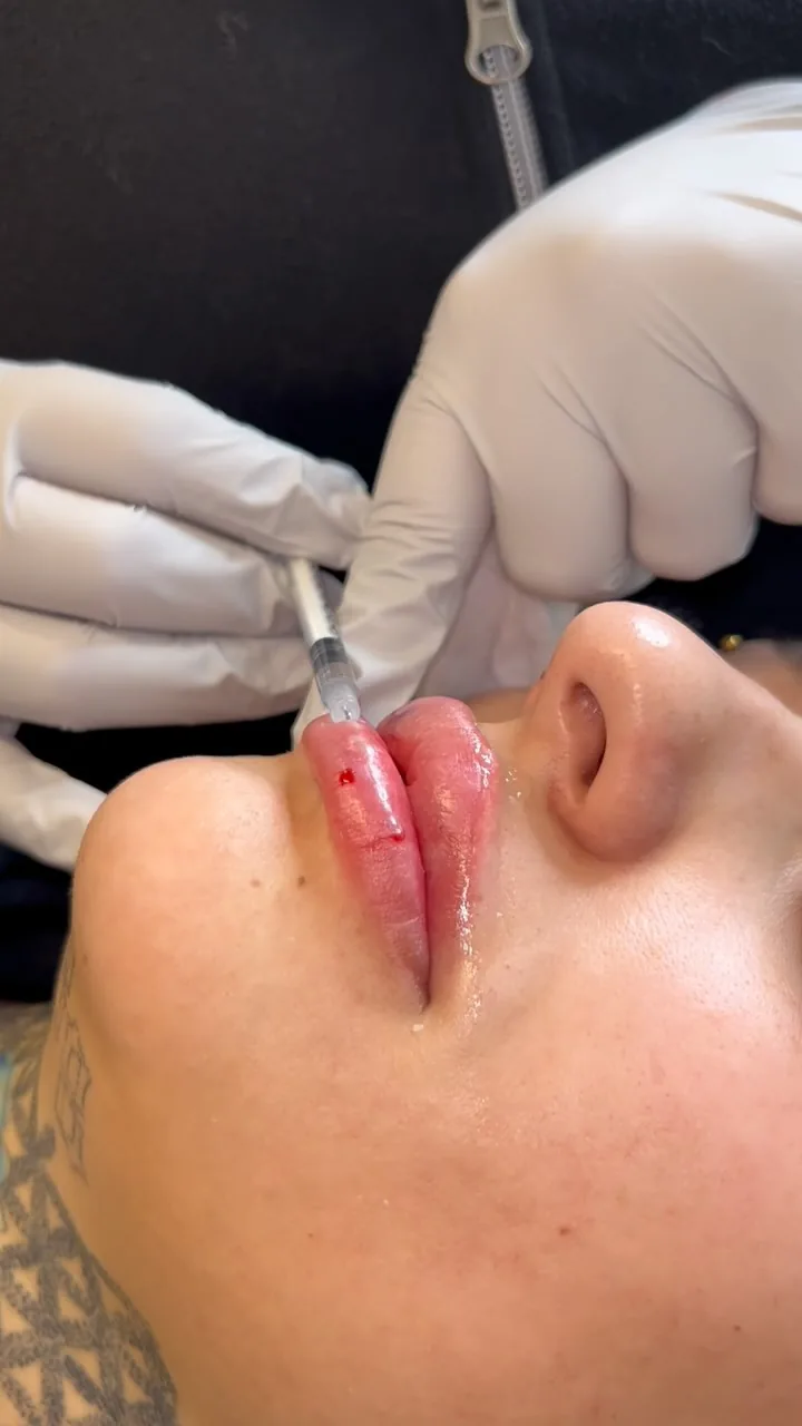 Dermal filler consultation near Scottsdale at Beauty Bar Aesthetics